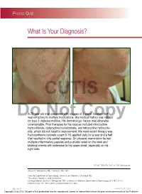 Demodex Folliculitis