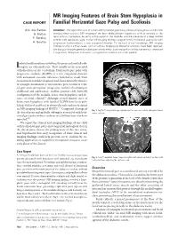 MR Imaging Features of Brain Stem Hypoplasia in Familial Horizontal