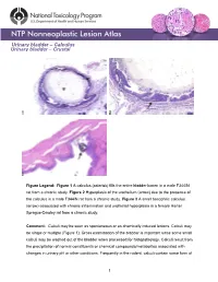 Urinary Bladder – Calculus Urinary Bladder – Crystal