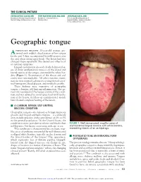 Geographic Tongue