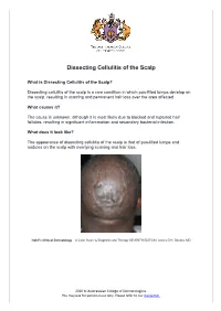 Dissecting Cellulitis of the Scalp