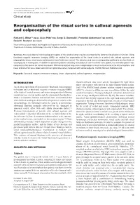 Reorganisation of the Visual Cortex in Callosal Agenesis and Colpocephaly