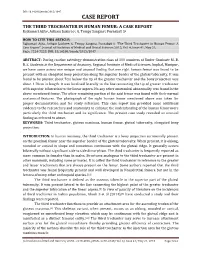 CASE REPORT the THIRD TROCHANTER in HUMAN FEMUR: a CASE REPORT Rajkumari Ajita1, Aribam Jaishree2, G