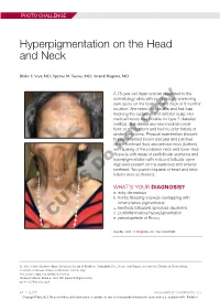 Hyperpigmentation on the Head and Neck