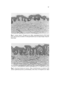Fig. 1. Lentigo Simplex. Elongated Rete Ridges, Hyperpigmentation of The