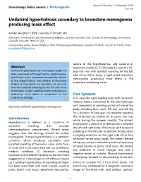Unilateral Hyperhidrosis Secondary to Brainstem Meningioma Producing Mass Effect