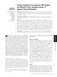 Pontine Tegmental Cap Dysplasia: MR Imaging and Diffusion Tensor Imaging Features of ORIGINAL RESEARCH Impaired Axonal Navigation