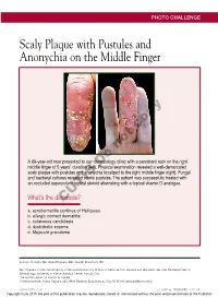 Scaly Plaque with Pustules and Anonychia on the Middle Finger