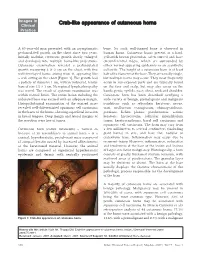 Crab-Like Appearance of Cutaneous Horns 14.6% with a Premalignant and 8.3% with a Malignant