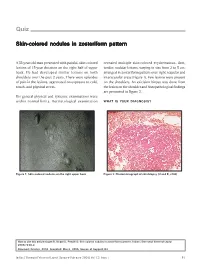 Skin-Colored Nodules in Zosteriform Pattern