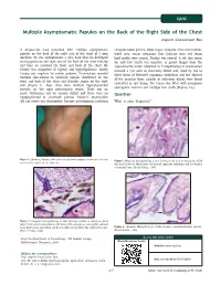 Multiple Asymptomatic Papules on the Back of the Right Side of the Chest Angoori Gnaneshwar Rao