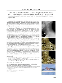 Thoracic Outlet Syndrome Caused by Pseudoarticulation of a Cervical Rib with the Scalene Tubercle of the First
