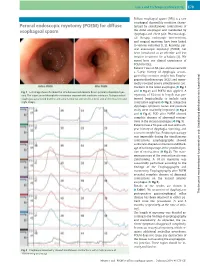 For Diffuse Esophageal Spasm… Endoscopy 2014; 46: E79–E81 E80 Cases and Techniques Library (CTL)