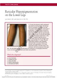 Reticular Hyperpigmentation on the Lower Legs