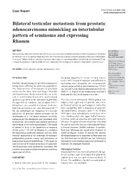 Bilateral Testicular Metastasis from Prostatic Adenocarcinoma Mimicking an Intertubular Pattern of Seminoma and Expressing Rhamm