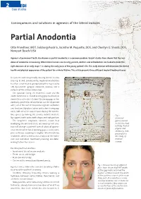 Partial Anodontia