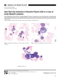 IMAGES in HEMATOLOGY Auer Rod-Like Inclusions in Reactive