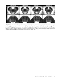 ON-LINE FIG 1. Selected Images of the Caudal Midbrain (Upper Row