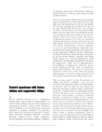 Down's Syndrome with Lichen Nitidus and Segmental Vitiligo