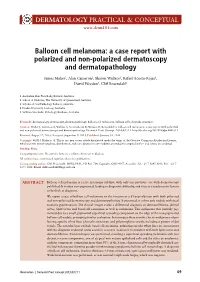 Balloon Cell Melanoma: a Case Report with Polarized and Non-Polarized Dermatoscopy and Dermatopathology. Dermatol Pract Concept. 2014; 4 (1): 11