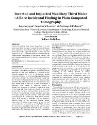 Inverted and Impacted Maxillary Third Molar : a Rare Incidental Finding in Plain Computed Tomography