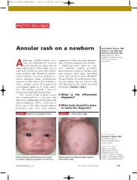 Annular Rash on a Newborn Keith A