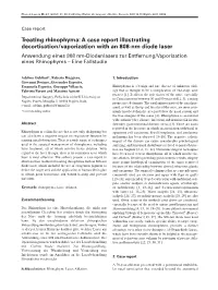 Treating Rhinophyma: a Case Report Illustrating Decortication/Vaporization with an 808-Nm Diode Laser