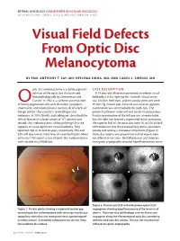 Visual Field Defects from Optic Disc Melanocytoma